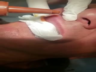 Паразит в губе