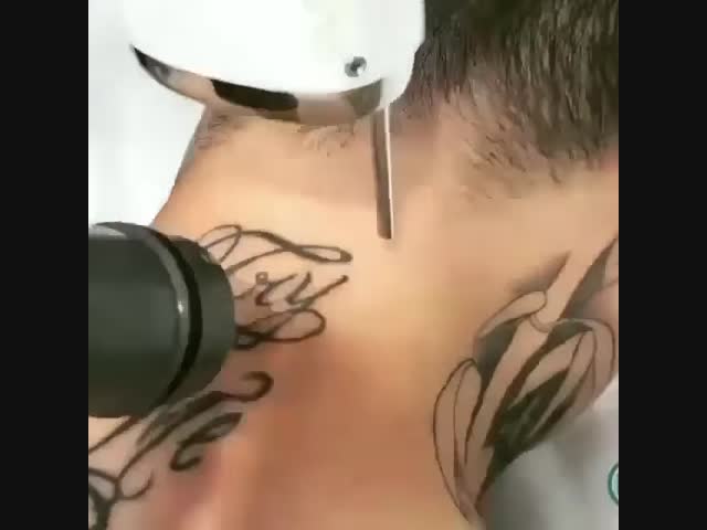 Лазерное удаление татуировки