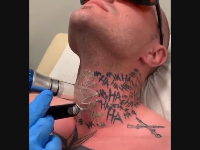 Лазерное удаление татуировки