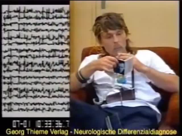 Мозг во время эпилептического приступа